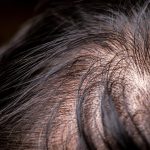 men adult hair loss . close up